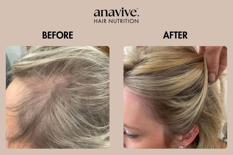 Before and after comparison of hair treatment with Anavive logo.